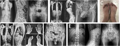 Exploring and expanding the phenotype and genotype diversity in seven Chinese families with spondylo-epi-metaphyseal dysplasia